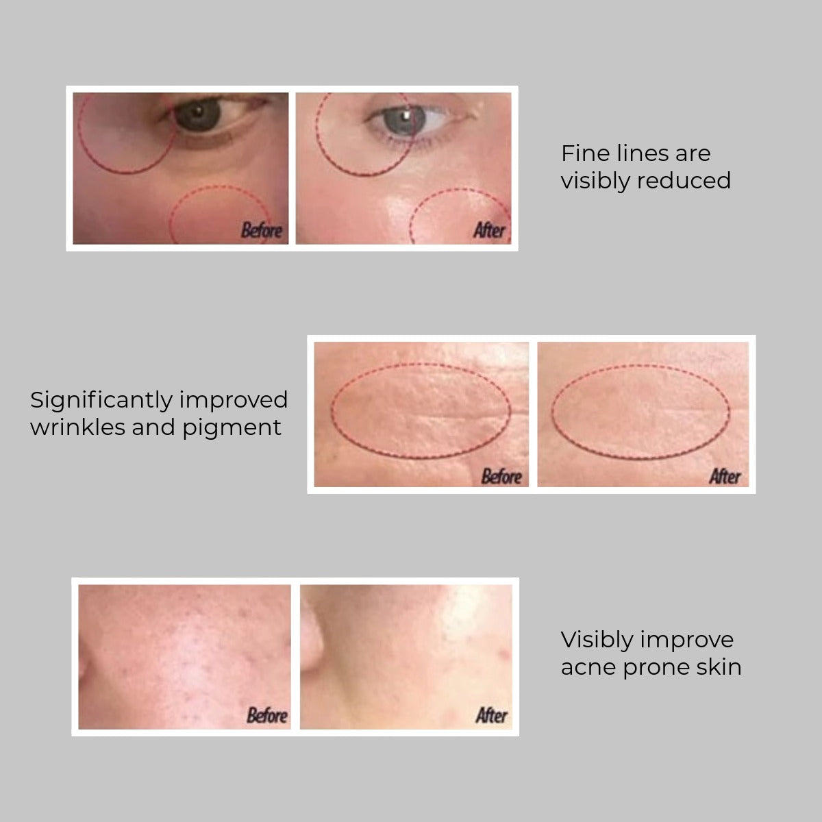 LED Light Therapy Face Mask